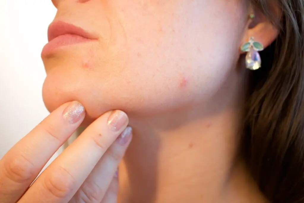 treating hormonal acne at home
